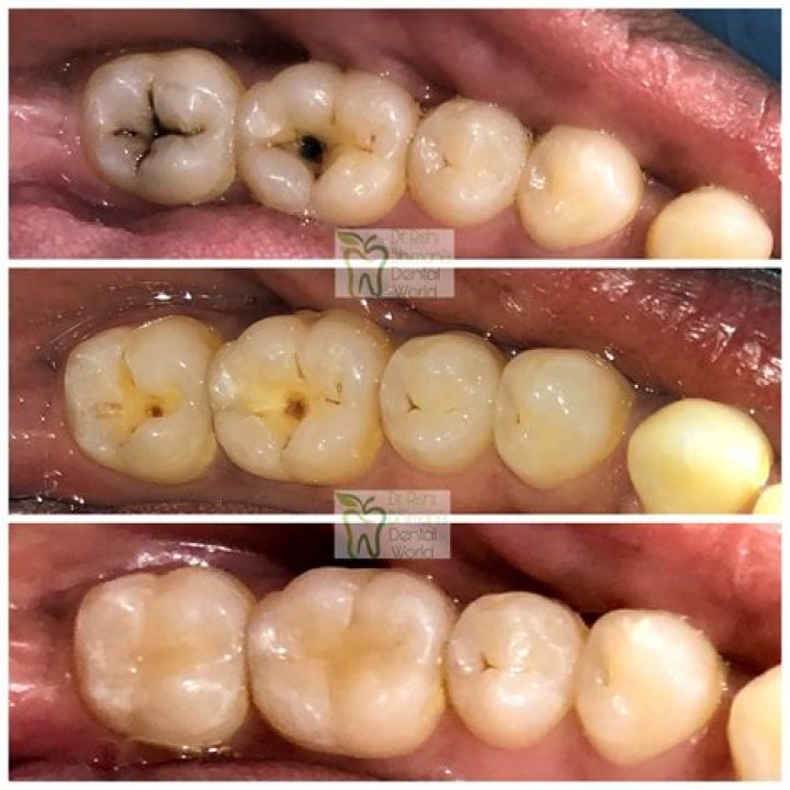 Are cavities common?