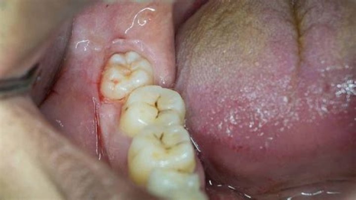 Are wisdom teeth painful?