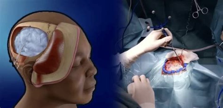 Can a craniotomy cause disability?