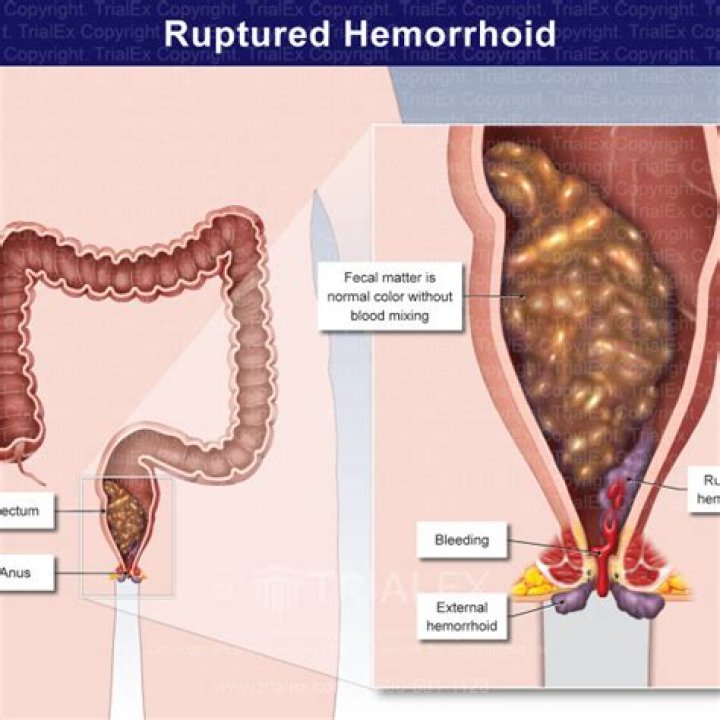 Can a hemorrhoid pop?