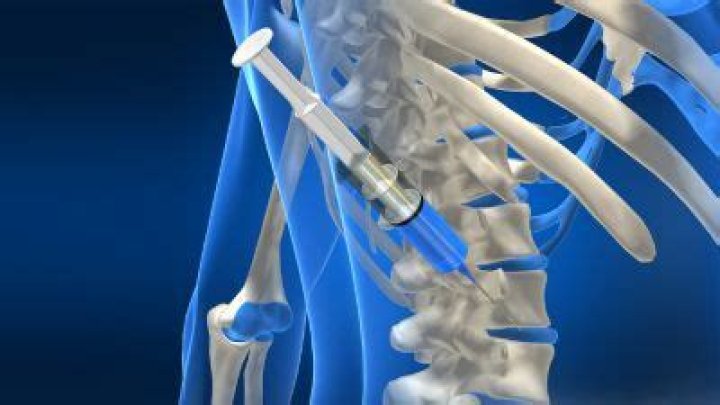 Can a steroid injection help piriformis syndrome?