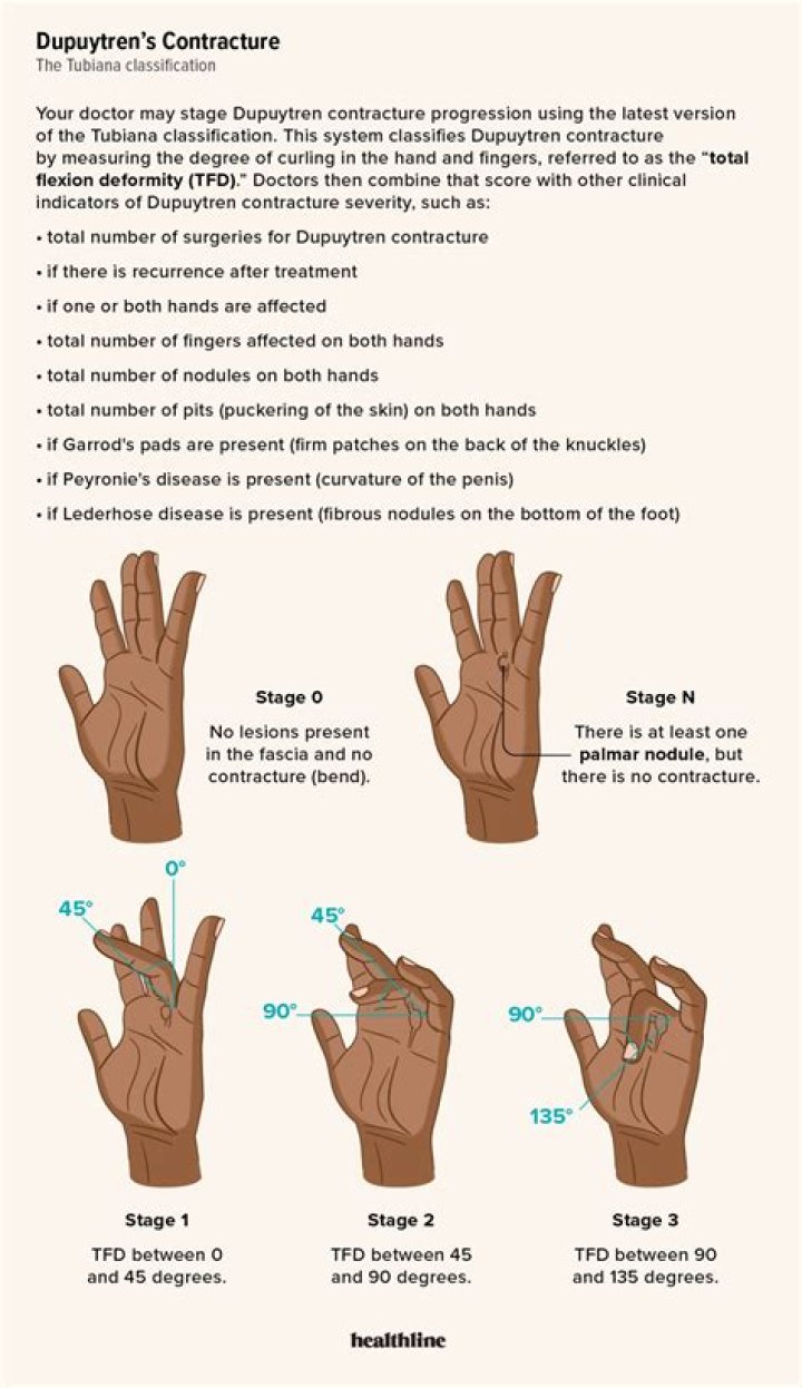 Can Dupuytren's contracture be reversed without surgery?
