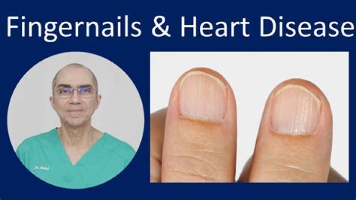 Can fingernails show signs of heart disease?