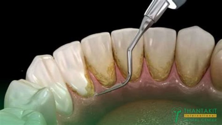 Can gums temporarily recede?