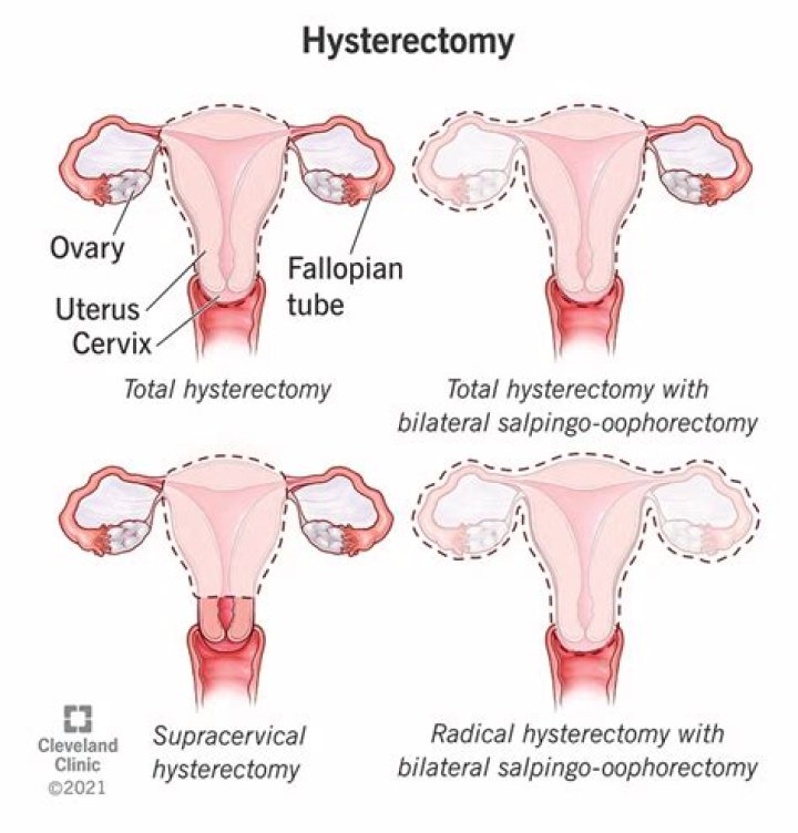 Can HPV come back after hysterectomy?