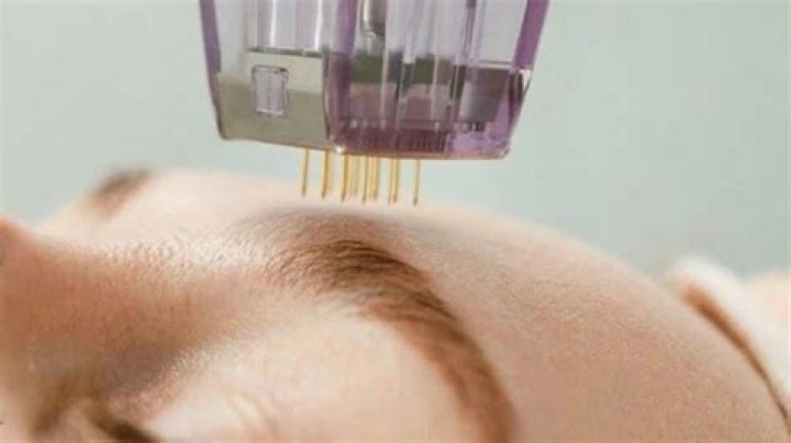 Can I drink coffee after microneedling?