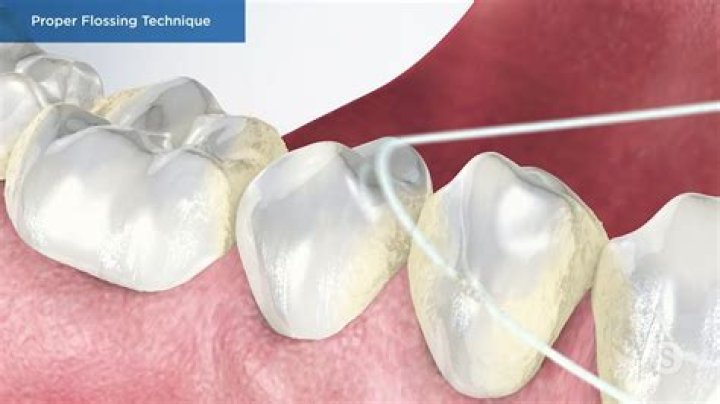 Can I floss with veneers?