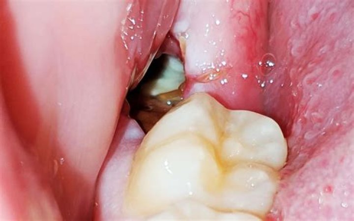 Can I swallow after tooth extraction?