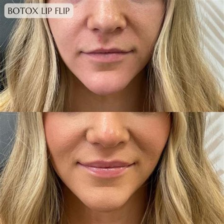 Can lip lift be done with fillers?