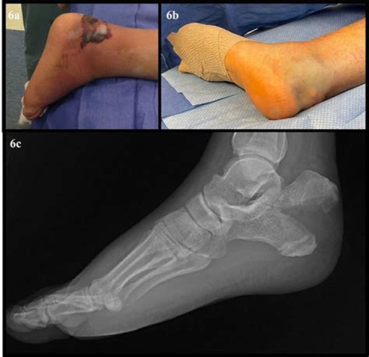 Can phantosmia be cured?