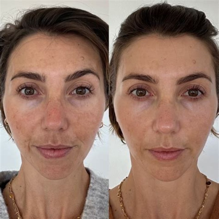 Can you see results after 1 peel?