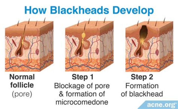Do blackheads leave holes in your face?