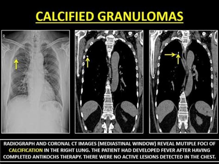 Do calcified granulomas go away?