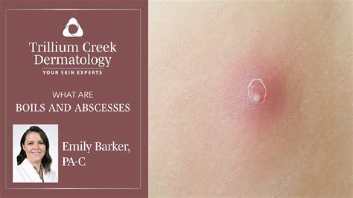 Do I have a boil or a cyst?