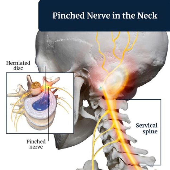 Do pinched nerves require surgery?
