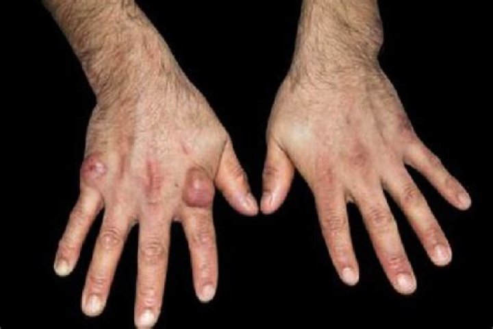 Do rheumatoid nodules burst?