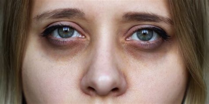 Does alcohol cause dark circles under eyes?