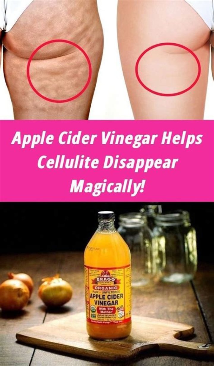 Does apple cider vinegar reduce cellulite?