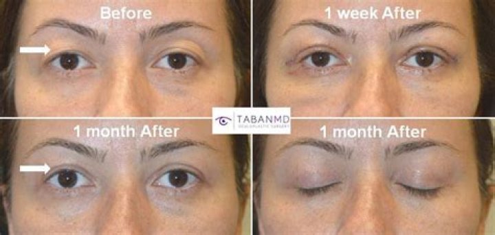Does blepharoplasty make you look younger?