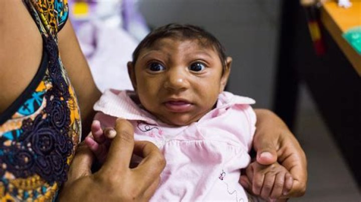 Does every pregnant woman with Zika have microcephaly?