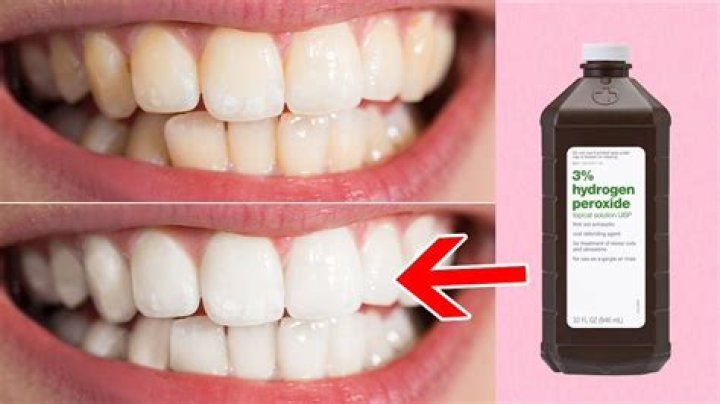Does hydrogen peroxide damage gums?