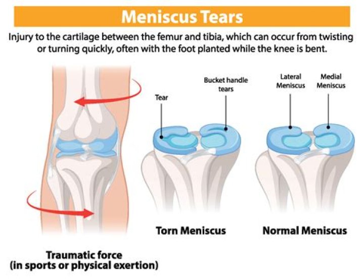 Does meniscus tear hurt to touch?