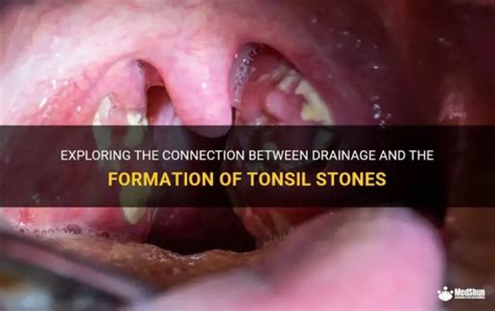 Does mono cause tonsil stones?