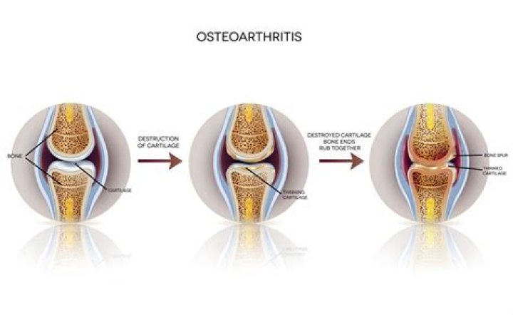 Does osteoarthritis hurt all the time?
