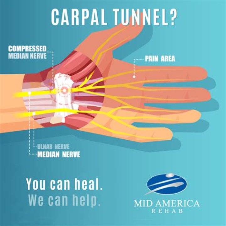 Does Voltaren Gel help carpal tunnel?