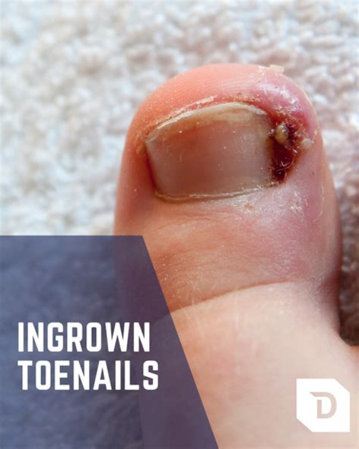 How can I remove an ingrown toenail myself?