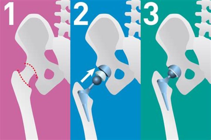 How do I get rid of limp after hip replacement?