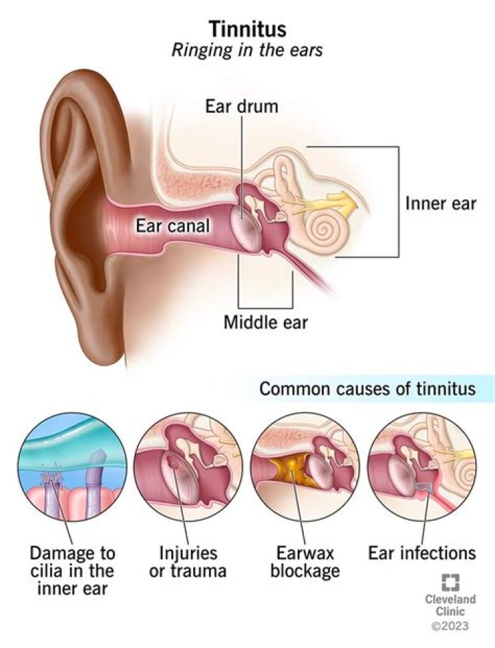 How do I know if my tinnitus is temporary?