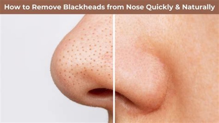 How do you exfoliate blackheads?