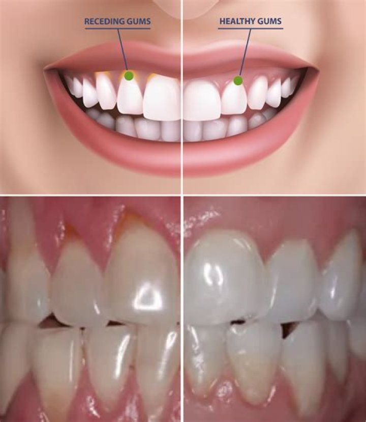 How do you fix severely receding gums?