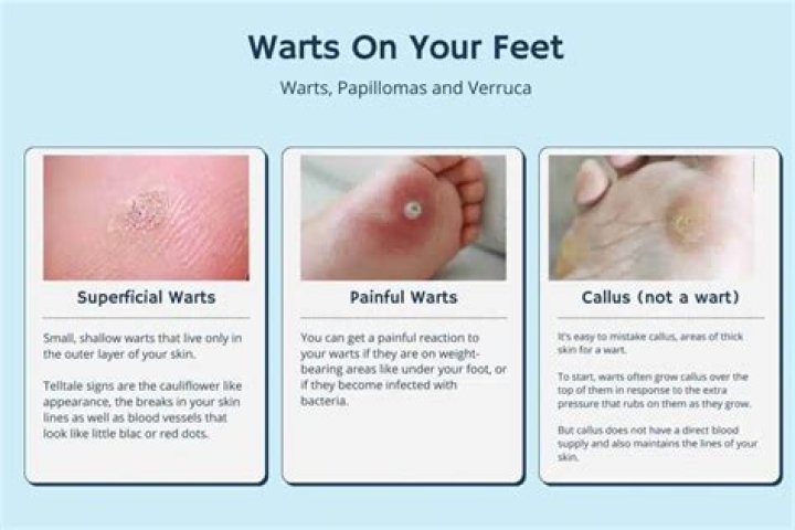 How do you get rid of HPV warts on your feet?