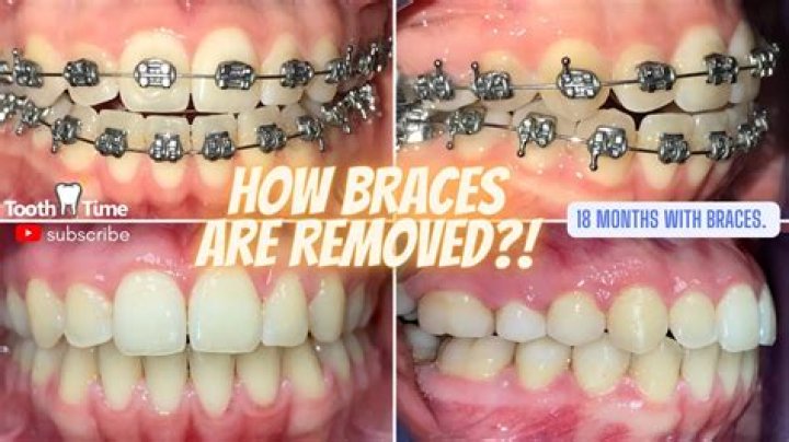 How long are teeth sore after braces tightened?