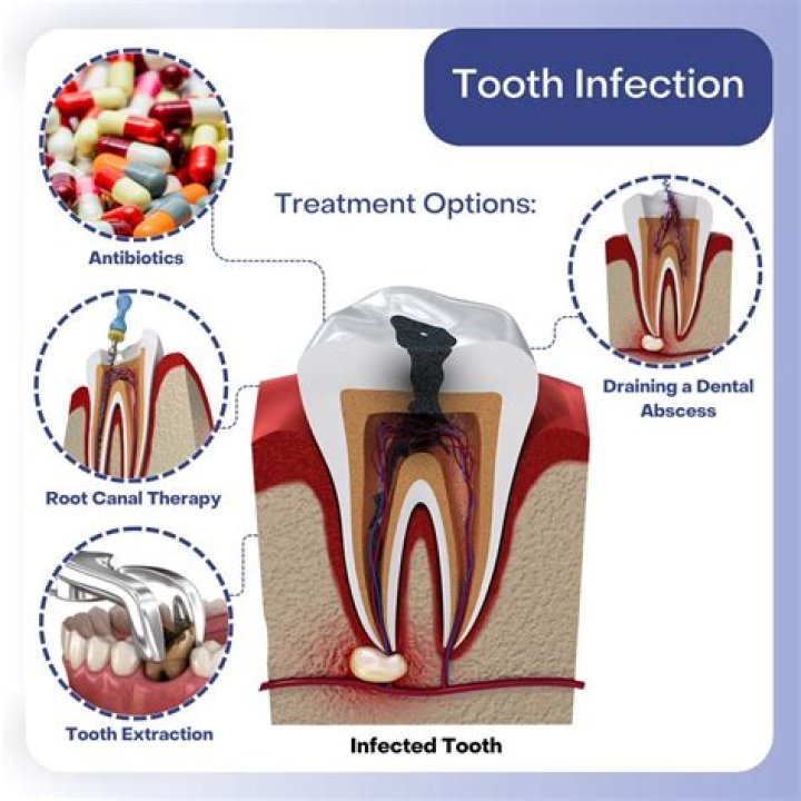 How long can you have a tooth infection before it kills you?