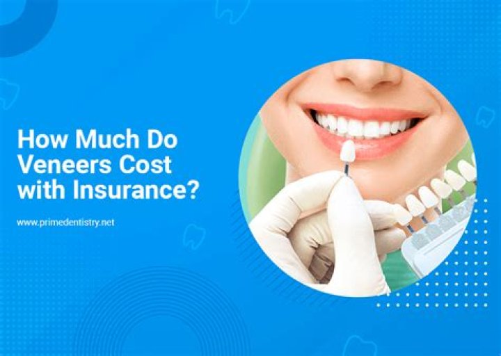How much do the cheapest veneers cost?