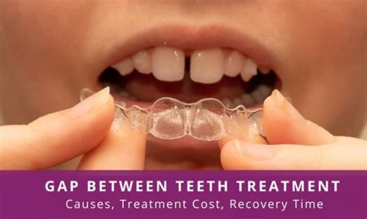How much does it cost to fix gap between teeth?