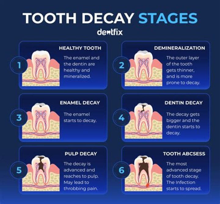 How quickly does tooth decay progress?
