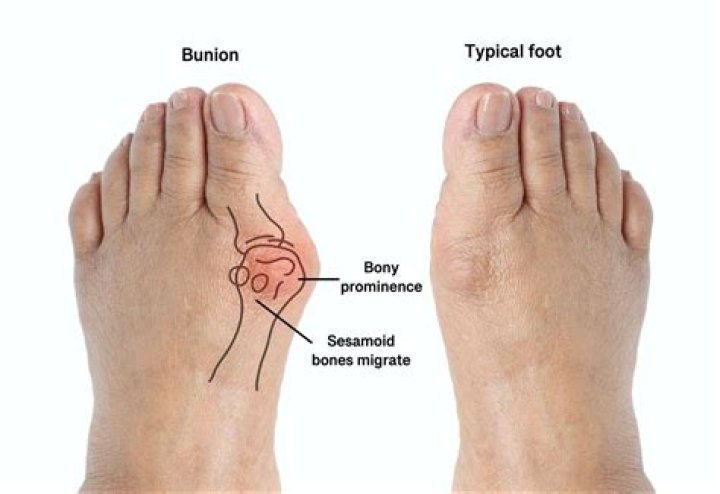 How soon can you put weight on your foot after bunion surgery?