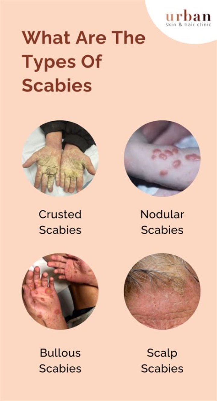 How will I know when my scabies are gone?