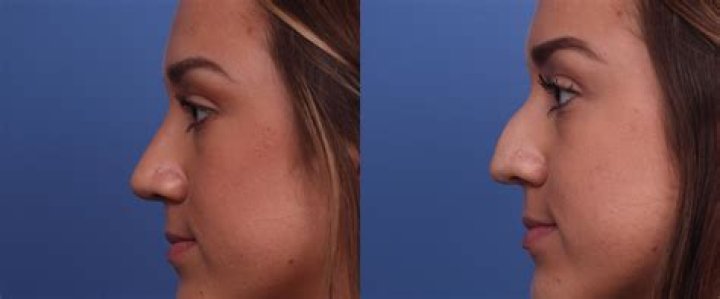 Is a nose job worth it?