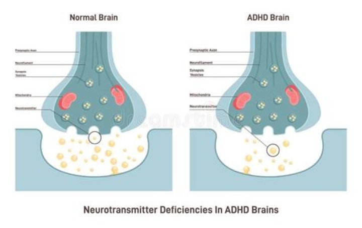 Is ADHD a dopamine deficiency?