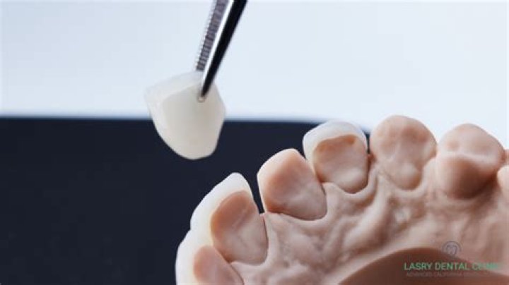 Is it easy to remove veneers?