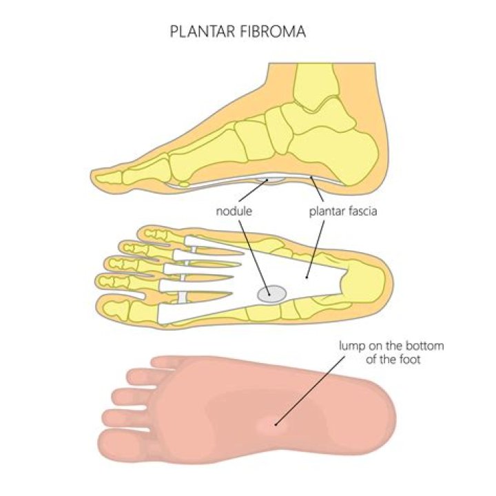 Is plantar fibroma the same as Ledderhose?