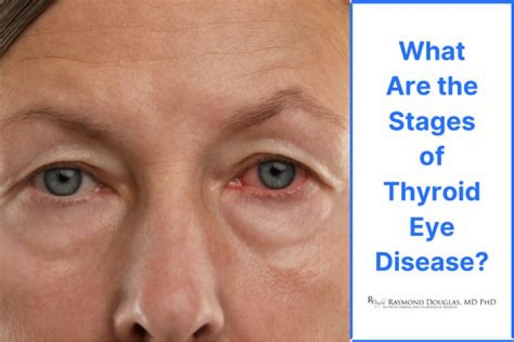 Is there a cure for thyroid eye disease?