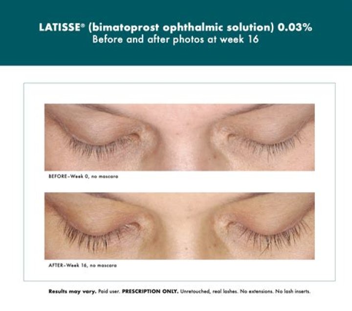 Is there a generic version of Latisse?