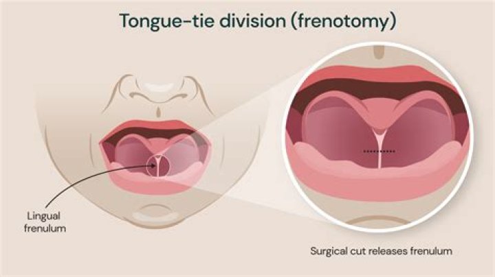 Is tongue-tie surgery painful?