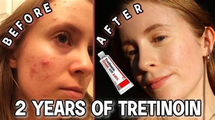 Is using tretinoin 3 times a week enough?